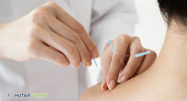 صورة توضيحية لـ الوخز بالإبر لالتهاب المفاصل اليفعي: دليل شامل للآباء والأطفال في اليمن مع الأستاذ الدكتور محمد هطيف