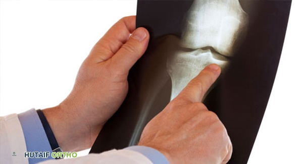 صورة توضيحية لقرار إجراء عملية جراحية في المفاصل