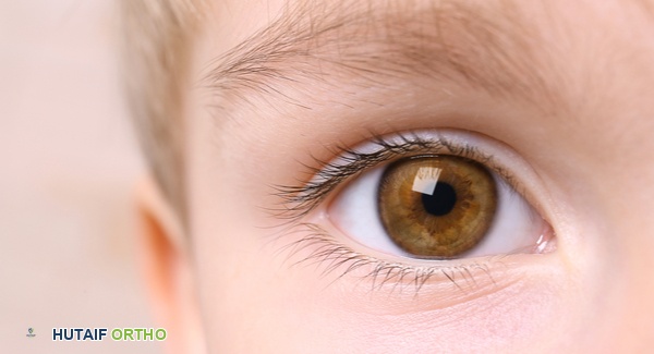 صورة توضيحية لعين سليمة وأخرى مصابة بالتهاب العنبية المرتبط بالتهاب المفاصل، مع التركيز على منطقة القزحية