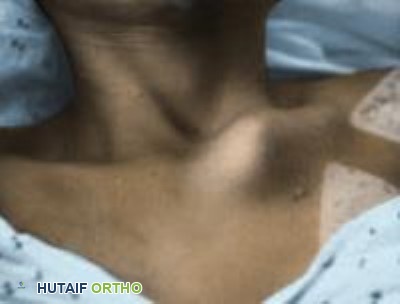 صورة توضيحية لـ اضطرابات المفصل القصي الترقوي: دليلك الشامل للعلاج والتعافي مع الأستاذ الدكتور محمد هطيف