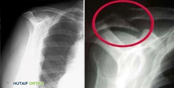 صورة توضيحية لـ انحشار الكتف والتهاب أوتار الكفة المدورة: دليل شامل للتشخيص والعلاج مع الأستاذ الدكتور محمد هطيف في صنعاء