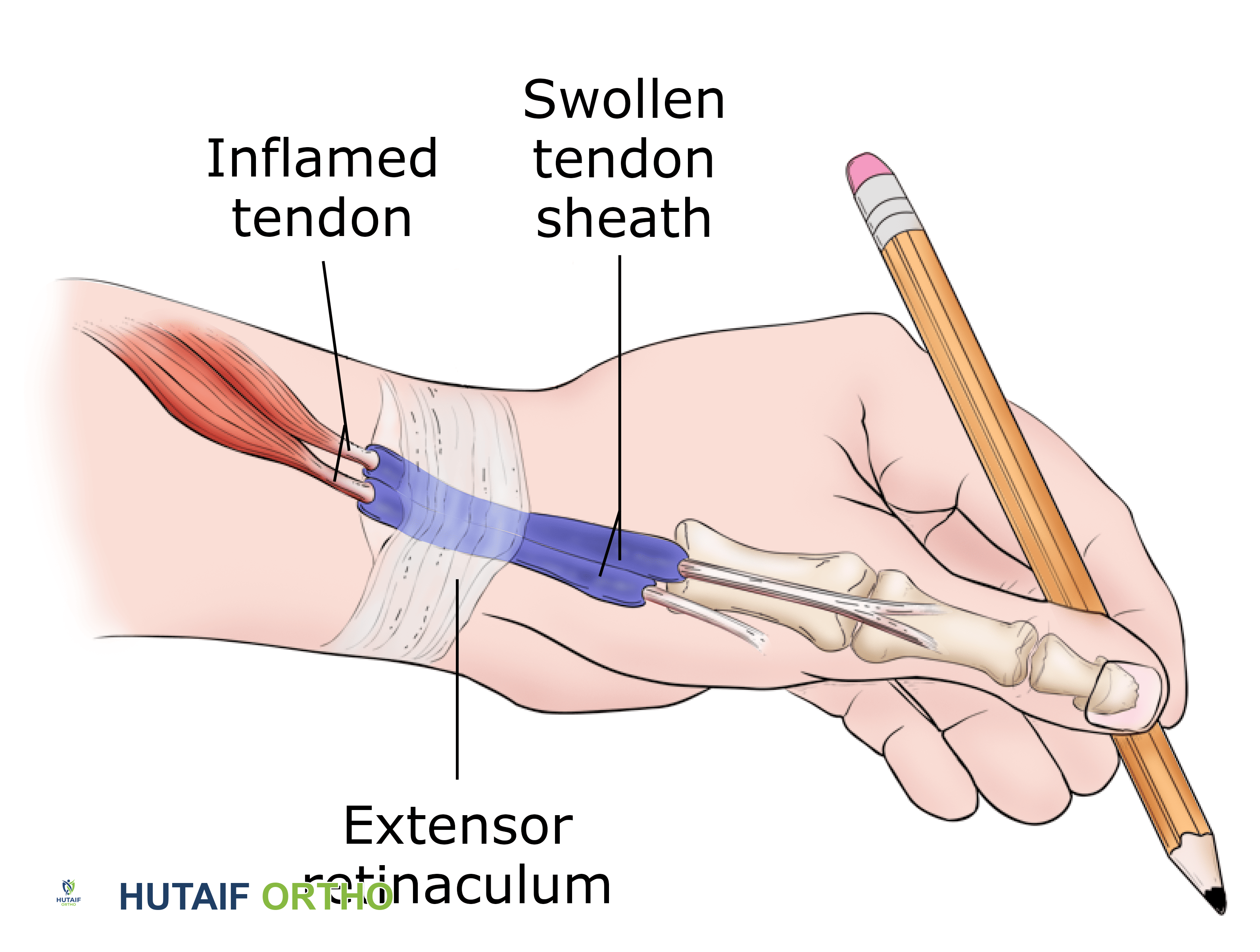 التهاب وتر دي كيرفان: دليل شامل من الأستاذ الدكتور محمد هطيف بصنعاء