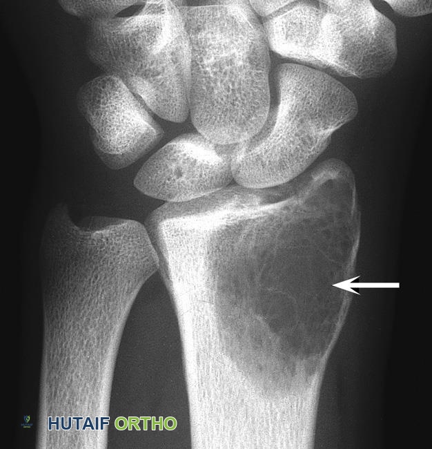 ورم الخلايا العملاقة في العظم: دليل شامل للمرضى مع الأستاذ الدكتور محمد هطيف