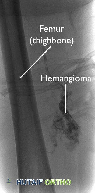 الأورام الوعائية والتشوهات الوعائية: دليل شامل للمرضى مع الأستاذ الدكتور محمد هطيف
