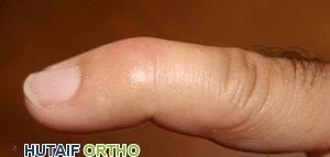 إصبع المطرقة: دليلك الشامل لفهم الإصابة والعلاج والتعافي