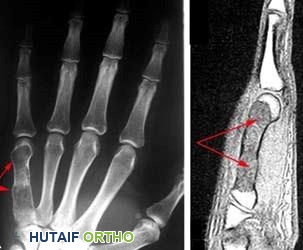 الورم الغضروفي الداخلي (Enchondroma): دليل شامل للمرضى مع الأستاذ الدكتور محمد هطيف