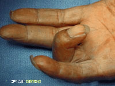 الإصبع الزنادي: الدليل الشامل لأسباب الأعراض والعلاج مع الأستاذ الدكتور محمد هطيف في صنعاء