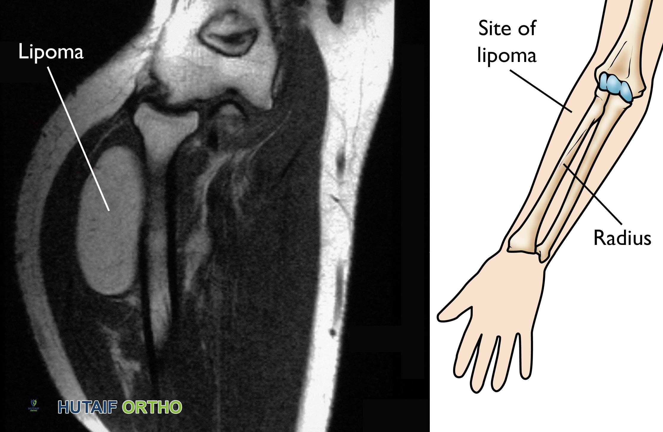 الورم الشحمي والأورام الشحمية اللانمطية: دليل شامل من الأستاذ الدكتور محمد هطيف
