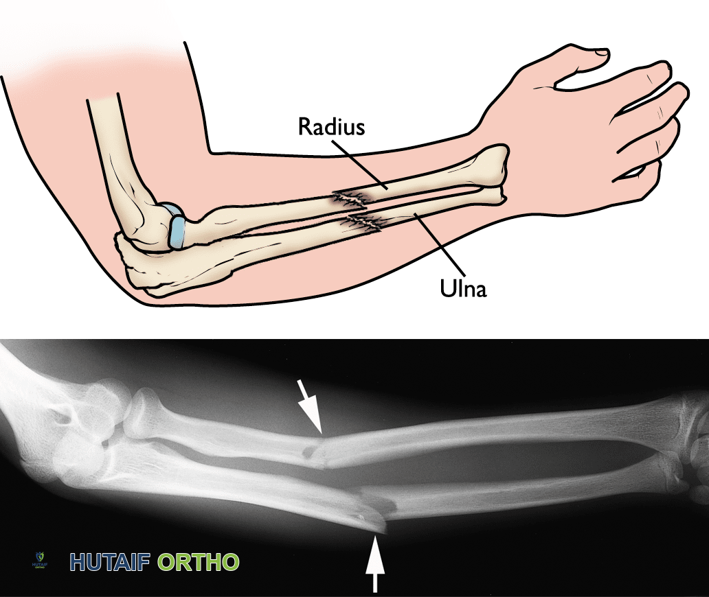 كسور الساعد لدى البالغين الأسباب الأعراض العلاج والتعافي في صنعاء مع الأستاذ الدكتور محمد هطيف