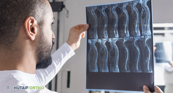 صورة توضيحية لعمود فقري متأثر بالتهاب الفقار اللاصق يظهر عليه الاندماج والتقوس