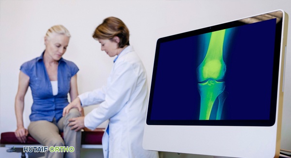 صورة توضيحية لـ مخاطر ومشاكل مفاصل الورك المعدنية بالكامل: دليلك الشامل من الأستاذ الدكتور محمد هطيف في صنعاء
