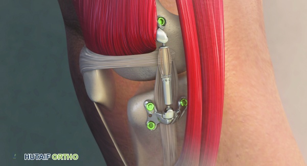 الطب عن بعد لخشونة الركبة