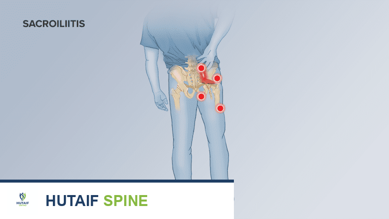 التهاب المفصل العجزي الحرقفي كل ما تحتاج لمعرفته مع الأستاذ الدكتور محمد هطيف