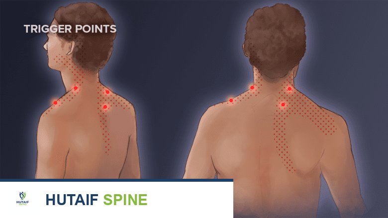 صورة توضيحية لـ تشوه الإبهام داخل الكف في الشلل الدماغي: دليل شامل للعلاج والتعافي مع الأستاذ الدكتور محمد هطيف