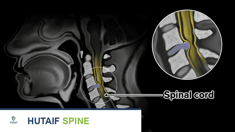 MRI-like illustration of Cervical Myelopathy with Spondylosis