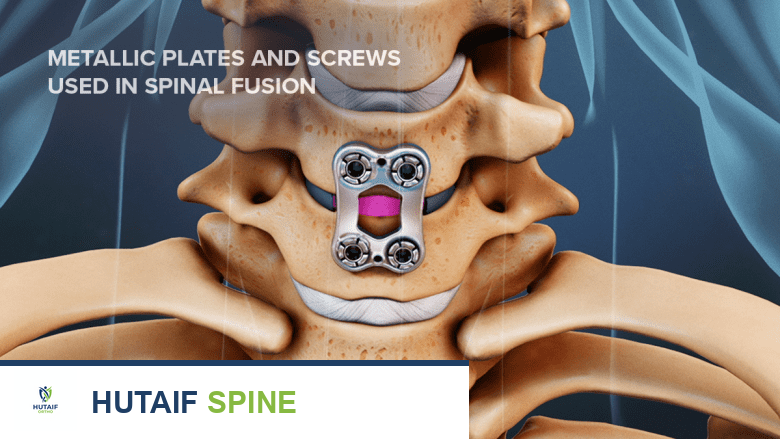 محفزات نمو العظام الخارجية لدمج العمود الفقري: دليل شامل للمرضى مع الأستاذ الدكتور محمد هطيف