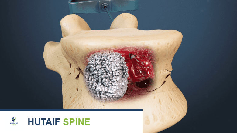 مخاطر ومضاعفات قسطرة الفقرات المحتملة: دليل شامل للمرضى مع الأستاذ الدكتور محمد هطيف
