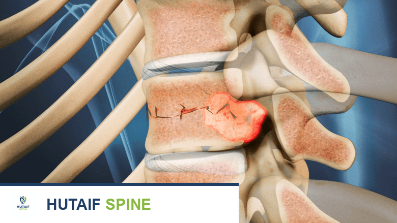 أعراض أورام العمود الفقري المنتشرة: دليل شامل للمرضى مع الأستاذ الدكتور محمد هطيف