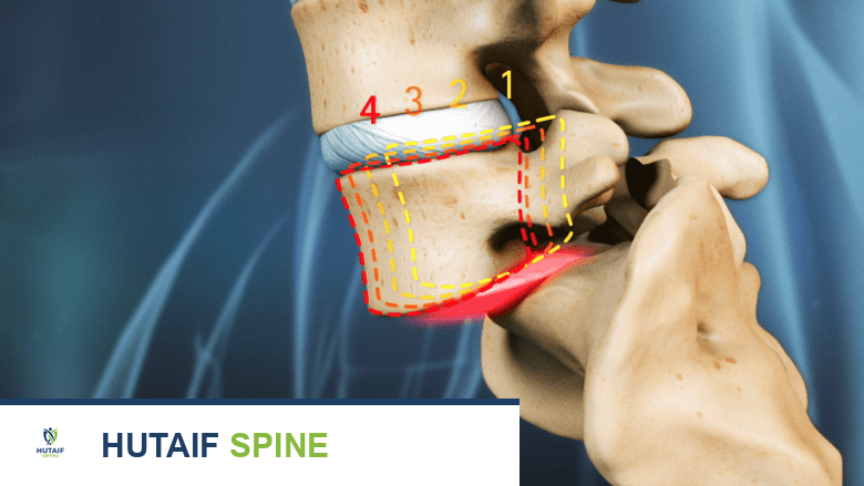 علاج الانزلاق الفقاري البرزخي بدون جراحة: دليل شامل لاستعادة حياتك الطبيعية