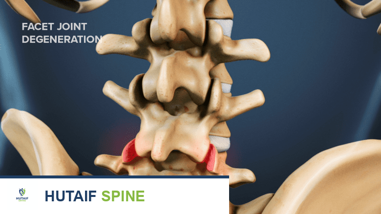 خشونة العمود الفقري: دليل شامل للأسباب والأعراض والعلاج في صنعاء مع الأستاذ الدكتور محمد هطيف