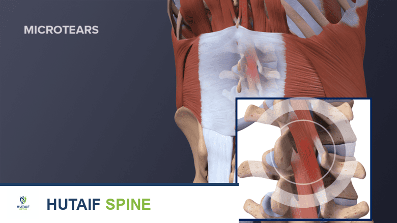 شد عضلة الظهر وإجهاد أسفل الظهر: دليل شامل مع الأستاذ الدكتور محمد هطيف