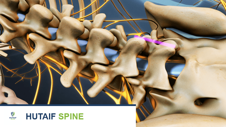دمج الفقرات القطنية: حل نهائي لآلام الظهر المزمنة واستعادة الثبات