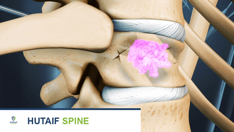 أنواع جراحات العمود الفقري القطني: دليلك الشامل لخيارات العلاج والتعافي مع الأستاذ الدكتور محمد هطيف