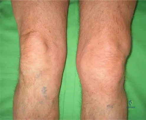 ABOS Orthopedic Board Review: Psoriatic Arthritis, Lipoma Arborescens, Down Syndrome, Scoliosis | Part 30