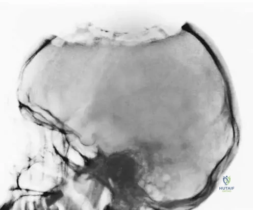 Master ABOS Orthopedic Review: Psoriatic Arthritis, Skeletal Dysplasias, LCH & Rare Bone Conditions | Part 28