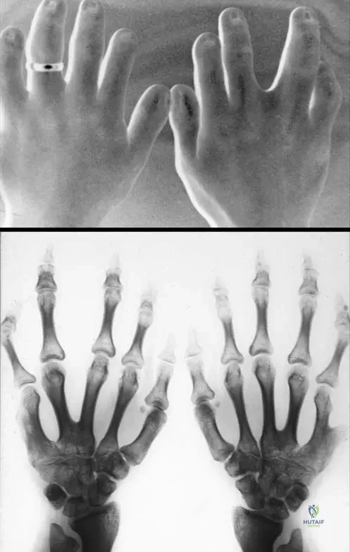 Ellis-Van Creveld Syndrome MCQs | Orthopedic Board Review