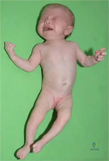 ABOS Orthopedic Board Review: Scoliosis, Ankylosing Spondylitis, Bone Tumors & Dysplasias | Part 31