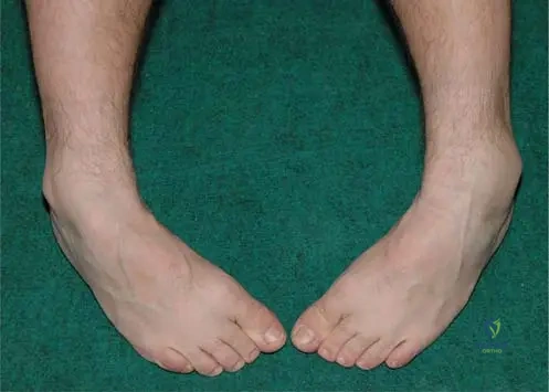 Dysplasia Epiphysealis Hemimelica (DEH) MCQs - Ortho Board