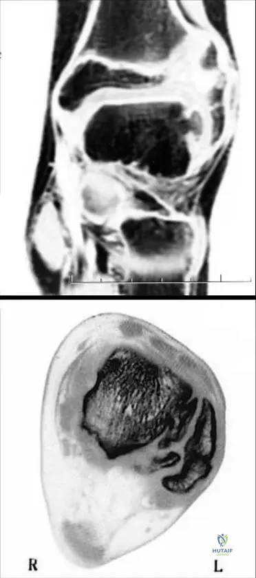 Dysplasia Epiphysealis Hemimelica (DEH) MCQs - Arab Board