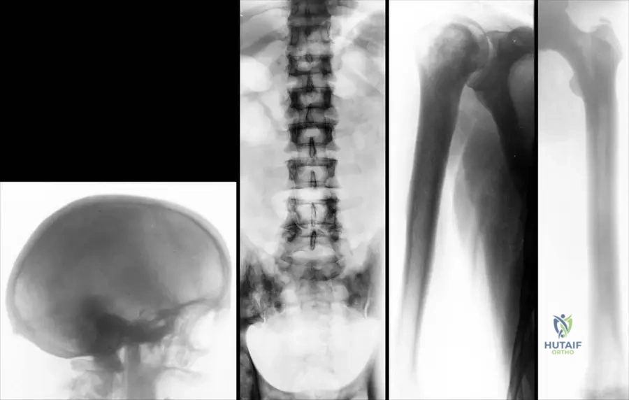 Orthopedic Board Review: Osteopetrosis, TRPS Type 1, & Paget's Disease Key Concepts | Part 4