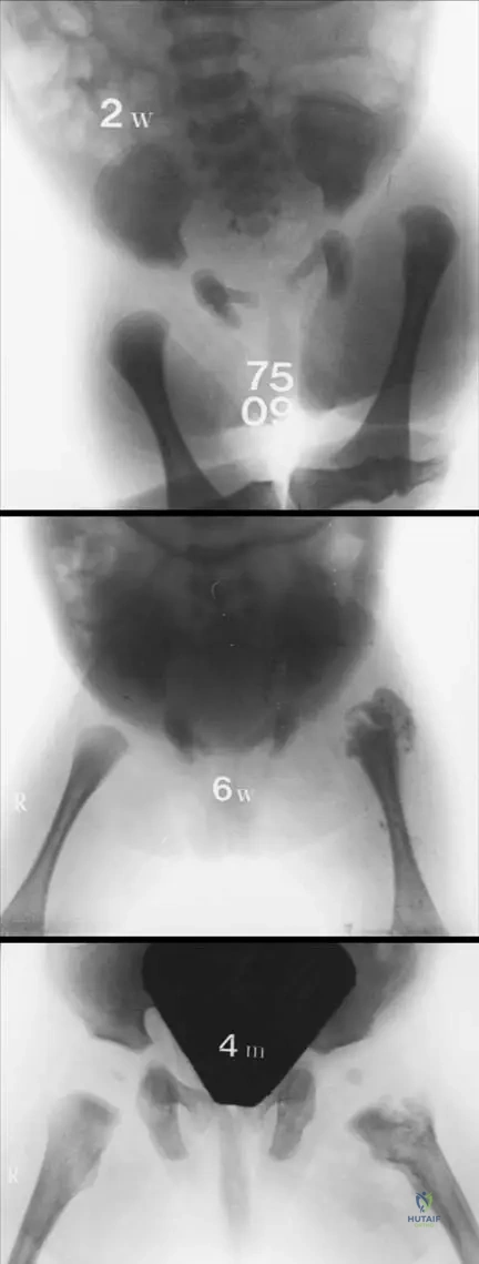 Master ABOS Orthopedic Board Review: Pediatric Infections, Tumors, & Skeletal Dysplasias | Part 6