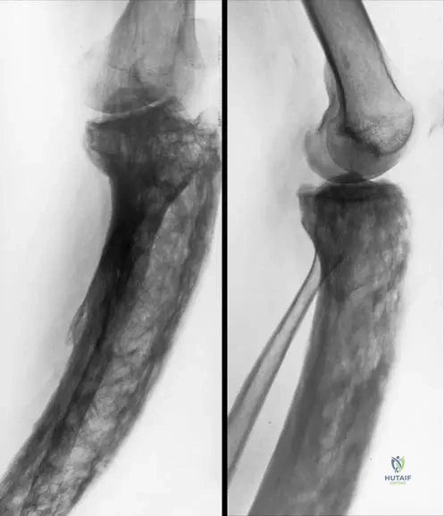 Master ABOS Orthopedic Board Review: Paget's, Gout, Hyperparathyroidism | Part 5