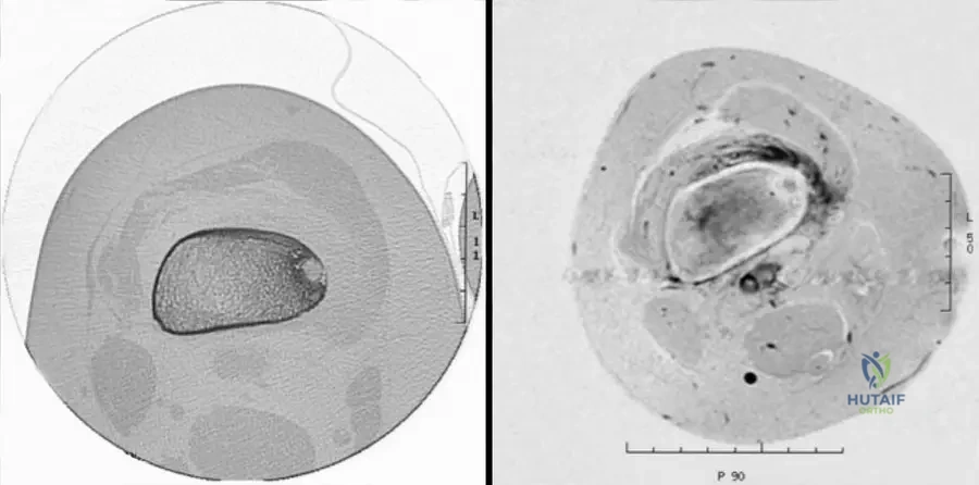 Master ABOS Orthopedic Board Review: Dysplasias, Tumors, Hemophilia, Fractures | Part 13