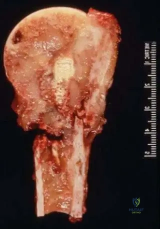 Master Orthopedic Board Review: Bone Tumors & Metabolic Diseases - Lymphoma, MPS, CMF | Part 11