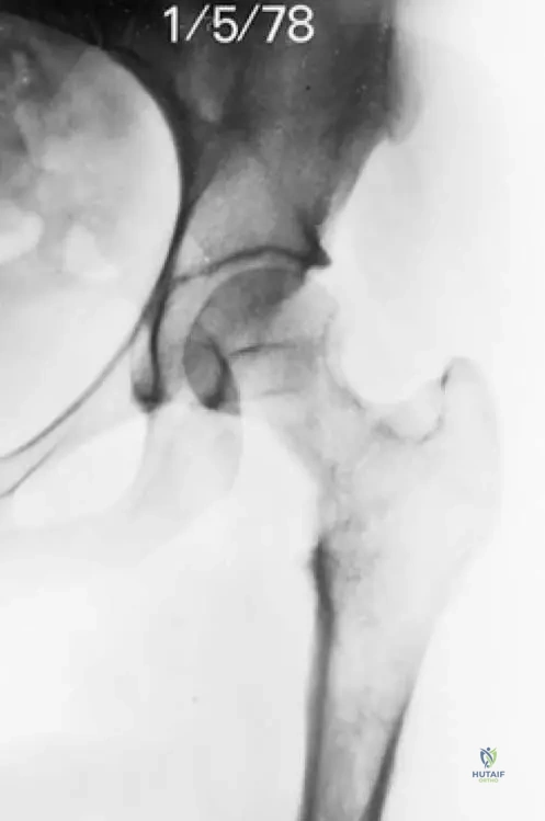 ABOS Orthopedic Board Review: Bone Tumors, Alcohol-Related Musculoskeletal Issues & PJI | Part 24