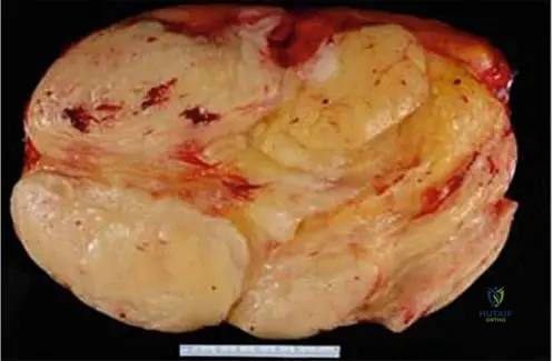 Orthopedic Board Review: Lipoma, Osteochondroma, AS, Synovial Chondromatosis MCQs | Part 15