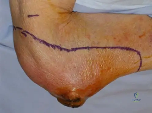 Master ABOS Orthopedic Board Review: Liposarcoma, Chondroblastoma, Syringomyelia | Part 17