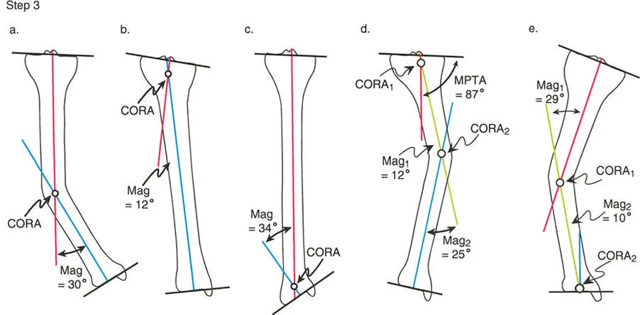 تصحيح تشوهات الأطراف السفلية المتقدمة: دليل شامل للمرضى مع الأستاذ الدكتور محمد هطيف