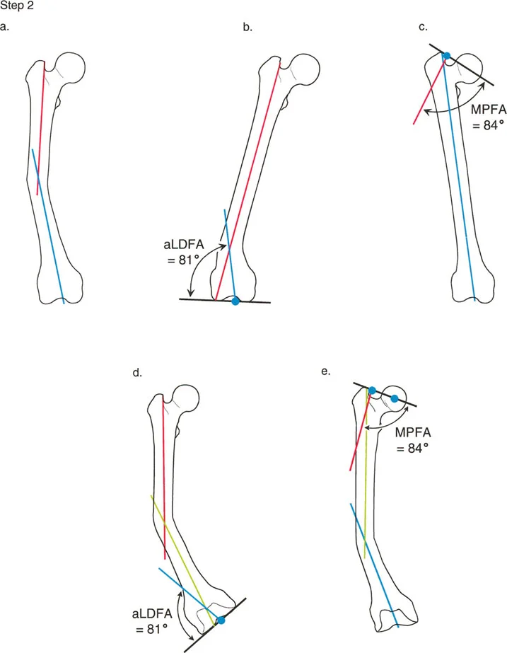 صورة طبية: تصحيح تشوهات الأطراف السفلية المتقدمة: دليل شامل للمرضى مع الأستاذ الدكتور محمد هطيف