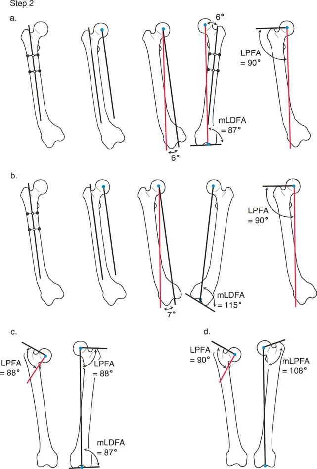 صورة توضيحية لـ تصحيح تشوهات الأطراف السفلية المتقدمة: دليل شامل للمرضى مع الأستاذ الدكتور محمد هطيف