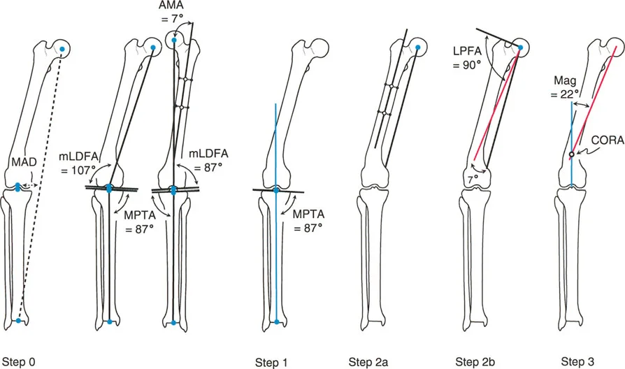 تصحيح تشوهات الأطراف السفلية بالمنهج الدقيق (بالي): استعادة المحاذاة والحياة الطبيعية