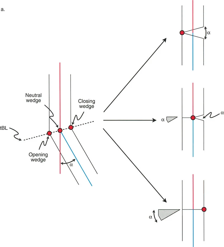 جراحة بالي لتصحيح تشوهات العظام: دليلك الشامل لاستعادة استقامة أطرافك
