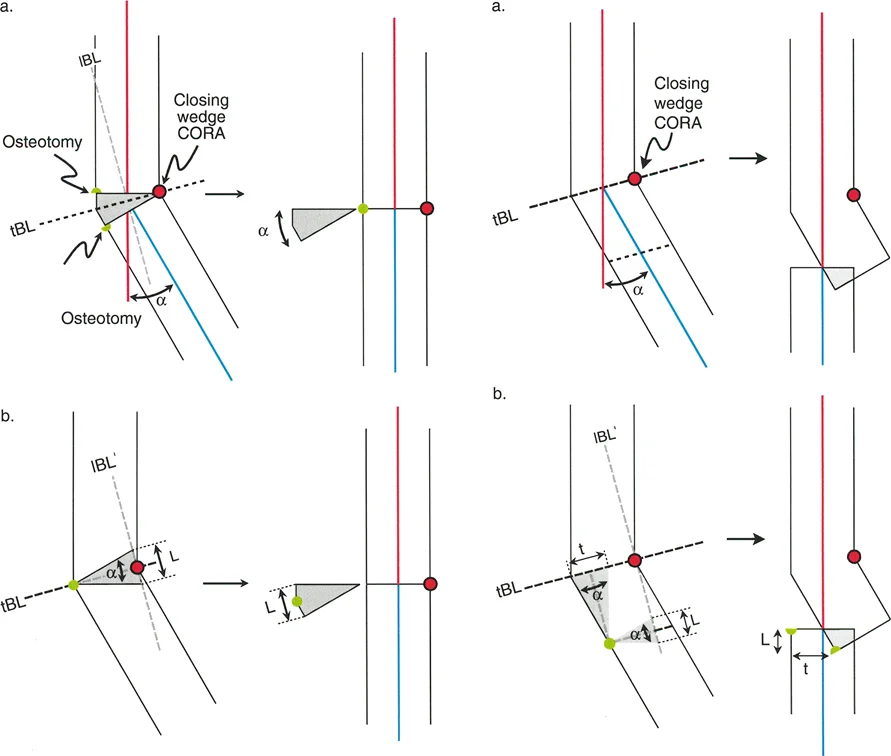 تصحيح تشوهات الأطراف السفلية بقطع العظم: دليل مبادئ بالي الشامل
