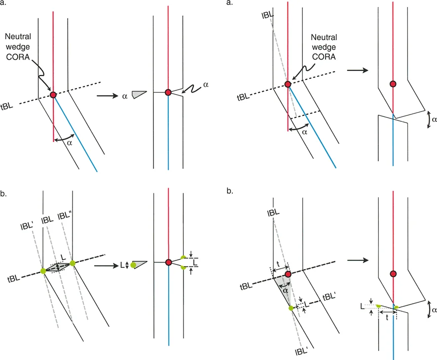 صورة توضيحية لـ قطع العظم بالي: حلول دقيقة لتصحيح تشوهات الأطراف واستعادة استقامتها