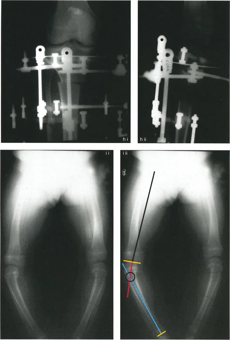 صورة طبية: إتقان قطع العظم القبة لتقويم تشوهات الأطراف: دليلك الشامل في صنعاء مع الأستاذ الدكتور محمد هطيف