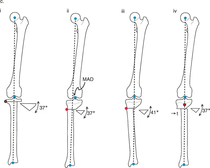 صورة توضيحية لـ إتقان قطع العظم القبة لتقويم تشوهات الأطراف: دليلك الشامل في صنعاء مع الأستاذ الدكتور محمد هطيف